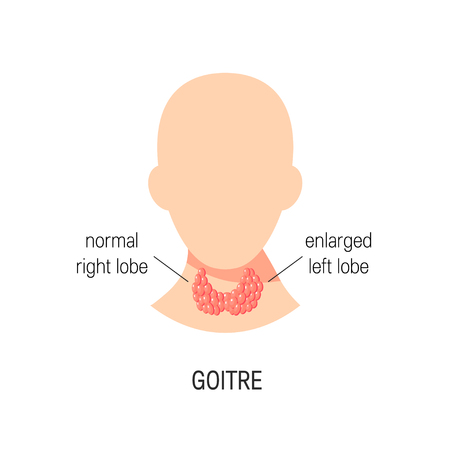 Goiter disease concept. Vector medical illustration of healthy and enlarged thyroid in flat styleのイラスト素材