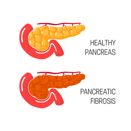 Pancreatic fibrosis concept. Medical vector illustration of healthy pancreas and damaged gland with chronic pancreatitisのイラスト素材