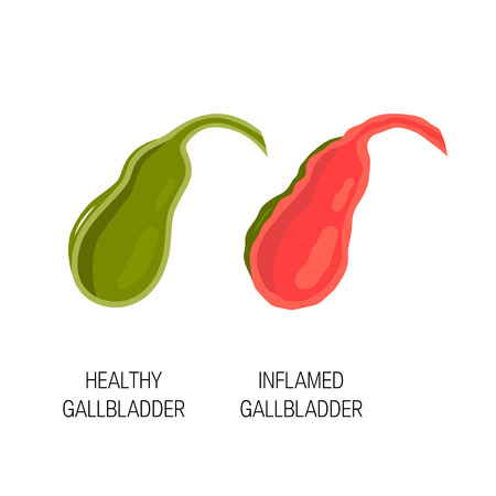 Biliary tract disease concept. Medical illustration of healthy and inflamed gallbladder. Vector illustration in flat style.のイラスト素材