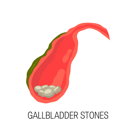 Biliary tract disease concept. Medical illustration of inflamed gallbladder with gallbladder stones. Vector illustration in flat style.のイラスト素材