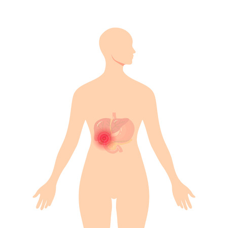 Gallbladder pain concept. Medical illustration of the bile duct and surrounding organs inside of female body. Simple vector illustration in flat style.のイラスト素材