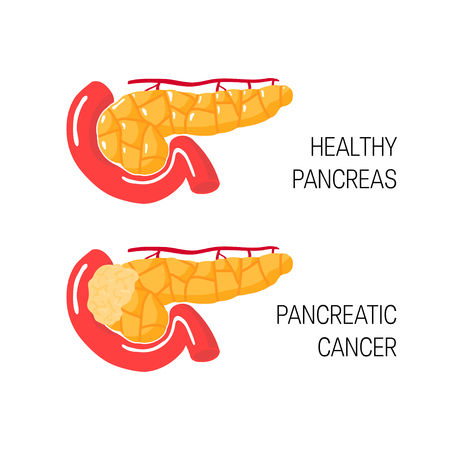 Pancreatic cancer concept. Medical vector illustration of healthy gland and pancreas with tumorのイラスト素材
