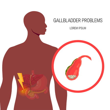Gallbladder disorder concept. Medical illustration of the inflamed gallbladder with gallstones and surrounding organs inside of black male body. Vector illustration in flat style. Template for bannersのイラスト素材