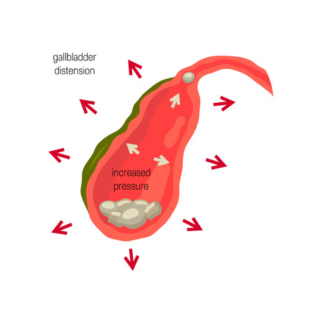 Cholelithiasis concept. Medical illustration of inflamed gallbladder with gallstones. Vector illustration in flat style.のイラスト素材