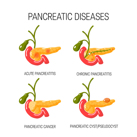 Diseases of the pancreas concept. Medical vector illustration of acute and chronic pancreatitis, pancreatic cyst ans cancer.のイラスト素材