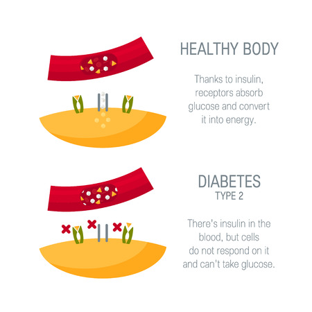 Diabetes type 2 concept. Diagram for medical infographic. Vector illustration in flat styleのイラスト素材