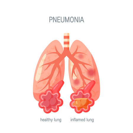 Pneumonia disease concept. Vector illustration in flat style for medical atlases, articles, infographics etc.のイラスト素材
