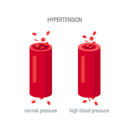 Hypertension concept. Healthy and narrowed human arteries. Vector illustration for articles, medical infographics in flat styleのイラスト素材