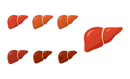 Liver diseases. Set of anatomical icons for medical designs. Vector illustration isolated on a white background in cartoon style.のイラスト素材