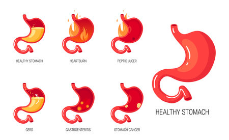 Stomach diseases. Set of anatomical icons for medical designs. Vector illustration isolated on a white background in cartoon style.のイラスト素材