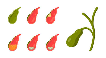 Gallbladder diseases. Bile duct concept. Anatomical icons for medical designs. Vector illustration isolated on a white background in cartoon style.のイラスト素材