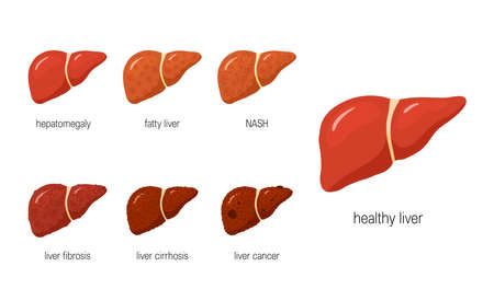 Liver diseases. Set of anatomical icons for medical designs. Vector illustration isolated on a white background in cartoon style.のイラスト素材