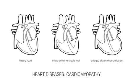 Heart diseases. Anatomical clip art for medical designs. Vector illustration isolated on a white background in outline style.のイラスト素材
