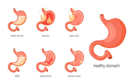 Stomach diseases. Set of anatomical icons for medical designs. Vector illustration isolated on a white background in cartoon style.のイラスト素材