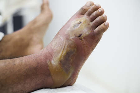 Close up view of a diabetic foot with inflammation and infection.の写真素材