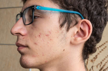 Close-up portrait on the skin of a young Caucasian boy in pubertal age: on his skin there are several recognizable pimples at different times of their life cycle. Selective focus.の写真素材