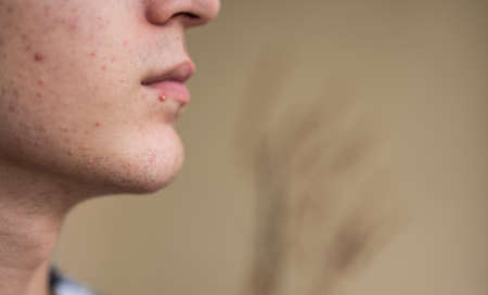 Close-up portrait on the skin of a young Caucasian boy in pubertal age: on his skin there are several recognizable pimples at different times of their life cycle. Selective focus.の写真素材