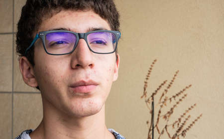 Close-up portrait on the skin of a young Caucasian boy in pubertal age: on his skin there are several recognizable pimples at different times of their life cycle. Selective focus.の写真素材
