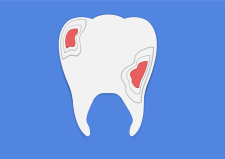 Vector tooth decay paper craft design.modern trend illustration.のイラスト素材