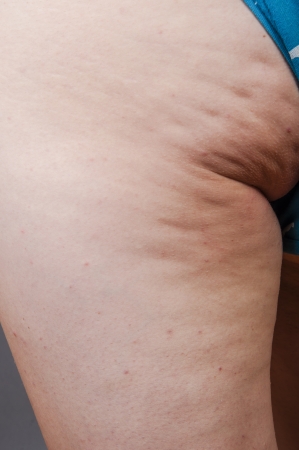 An image of cellulite on womens legsの写真素材