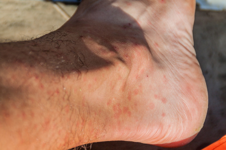 Leg covered by the bites of sandflies, jungle in Peruの写真素材
