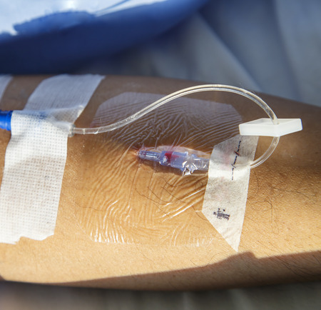IV needle on patient arm for medicine injection after surgeryの写真素材