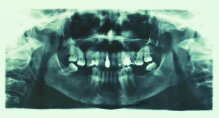 Clinical checkup X-ray dental detail の写真素材