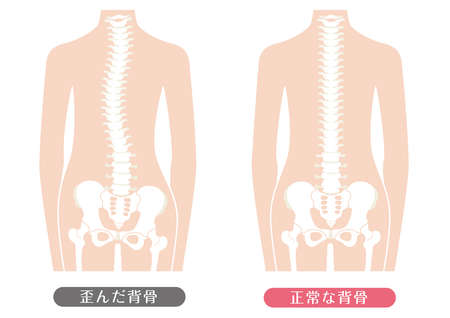 Human body Normal spine and distorted spine

It is described as "normal spine" and "distorted spine" in Japanese.のイラスト素材