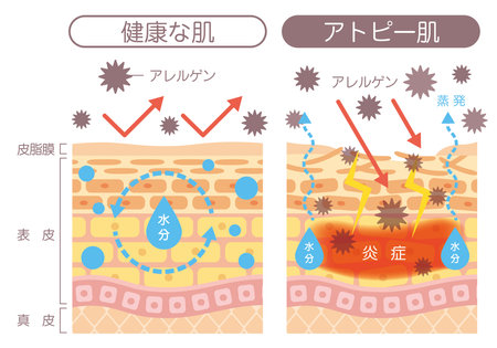 Structural diagram of the skin
Atopic dermatitis

Described in Japanese as "healthy skin," "atopic skin," "allergen," "moisture," and "inflammation."のイラスト素材