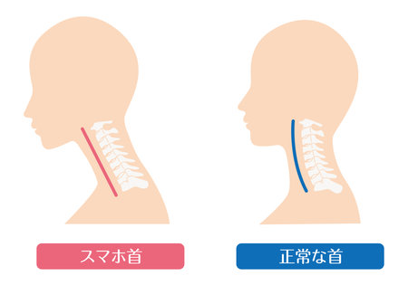 Comparison of smartphone neck and normal neck

In Japanese, it says "smartphone neck" and "normal cervical spine"のイラスト素材