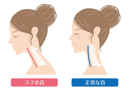 Woman's profile smartphone neck

In Japanese, it says "smartphone neck" and "normal cervical spine"のイラスト素材
