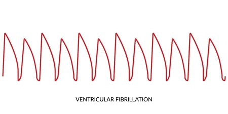 ECG Heartbeat Line. Electrocardiogram vector illustration. Ventricular Fibrillationのイラスト素材