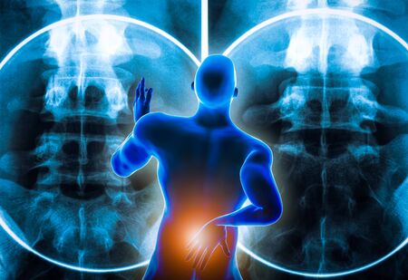 Back view of a man suffering from an acute lumbar back pain or discal hernia or lumbago with...