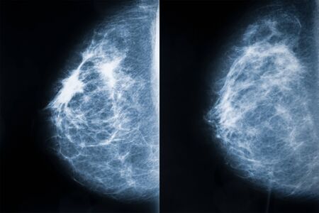 Comparison between breast carcinoma (left) and healthy breast (right). Breast cancer x-ray images or radiographs. Medical and healthcare imagery.の写真素材
