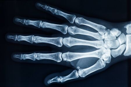 Human adult female right hand bones x-ray image. Medical and anatomy radiography or imagery.の写真素材