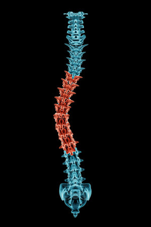 X-ray spinal column with scoliosis and pathological vertebrae highlighted in red. Human curvature of the spine disorder 3D rendering illustration. Medical and healthcare, medicine and anatomy concept.の写真素材