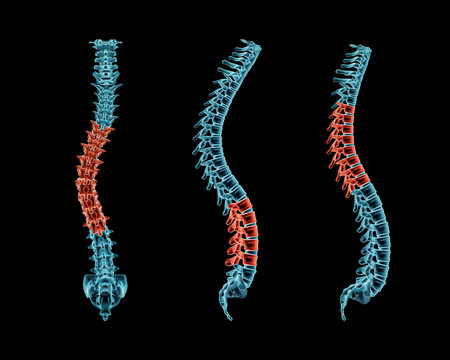 X-ray spinal column with scoliosis, lordosis and kyphosis postures. Pathological vertebrae highlighted in red. Human curvature of the spine disorders 3D rendering illustration. Medical and healthcare, medicine and anatomy concept.の写真素材