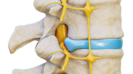 Herniated disc with spinal nerve compression 3D rendering illustration lateral view isolated on...