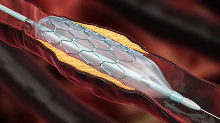 Angioplasty 3D rendering illustration. Stent delivery with dilated balloon within a diseased artery or blood vessel clogged by cholesterol atheroma plaque. Surgery, medicine, cardiology, healthcare, technology, science concepts.の写真素材