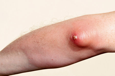 Olecranon bursitis and abscess at the elbow. Inflammation, infection of the skin, redness, hand swelling. Medical conceptの写真素材