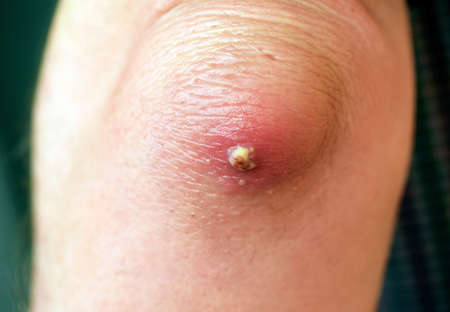 Olecranon bursitis and abscess at the elbow. Inflammation, infection of the skin, redness, hand swelling. Medical conceptの写真素材