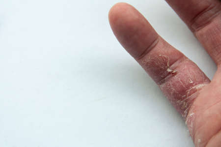 Skin disease for many people - eczema on hand and finger. White copy space for ideas or text.の写真素材