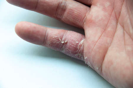 Skin disease for many people - eczema on hand and finger. White cover background.の写真素材