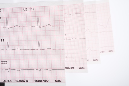 Photo of real electrocardiogram graphの写真素材