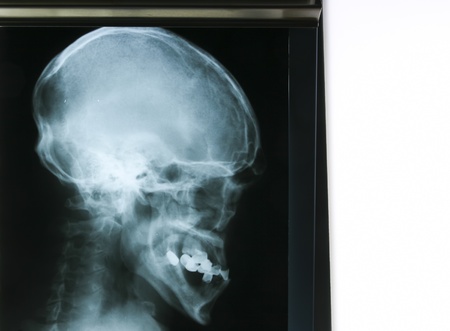X-ray of human teeth