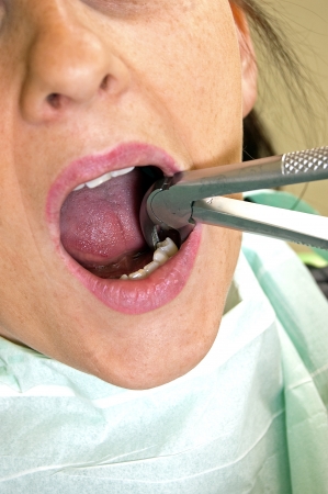 Young woman with a dentist pulling a toothの写真素材