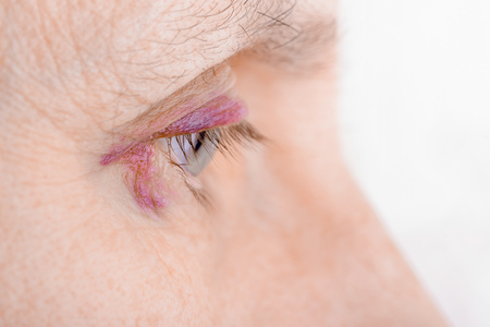 Woman's eye injured due to rupture of capillary, causing hematoma or bruising. It could also be conjunctivitis or other allergic eye inflammationの写真素材