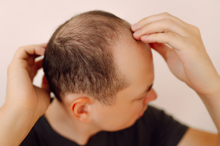 Baldness on the head of a middle-aged man. Hair loss. Male hair loss, early baldness and alopecia.の写真素材
