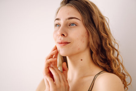 Portrait of a beautiful woman with inflammations on the skin of her face. Medicine and cosmetology.