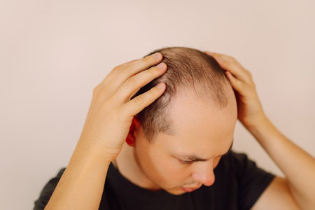 Baldness on the head of a middle-aged man. Hair loss. Male hair loss, early baldness and alopecia.の写真素材